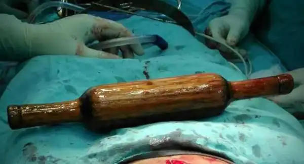 Pure Wickedness!! Man Forces Rolling Pin Inside His Wife “For Being Infertile” (Graphic Photos)